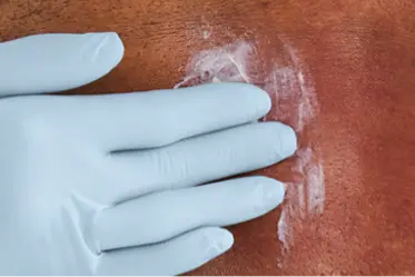 soothe-redness Gloved hand applies cream to highly irritated, open skin