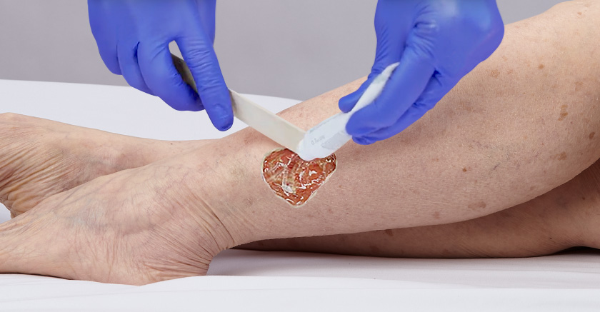 STK_SH_article_debridement_RGB