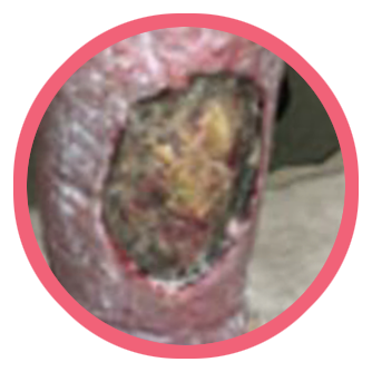 Close-up of wound that had been present for five months 