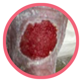 After using IoPlex, closeup of 100% granulation tissue on the same wound 28 days later 