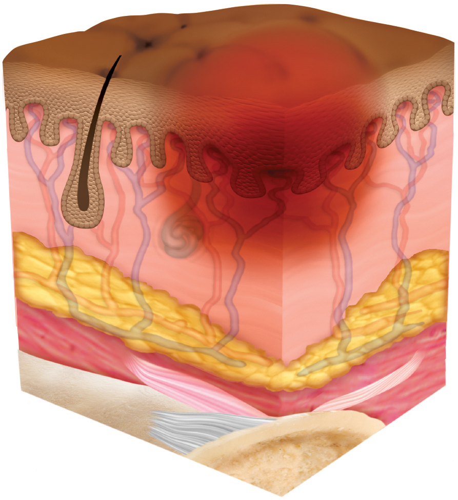 STK_Skin_Stage-1_dark Stage 1 pressure injury depicted as cross section through layers of skin