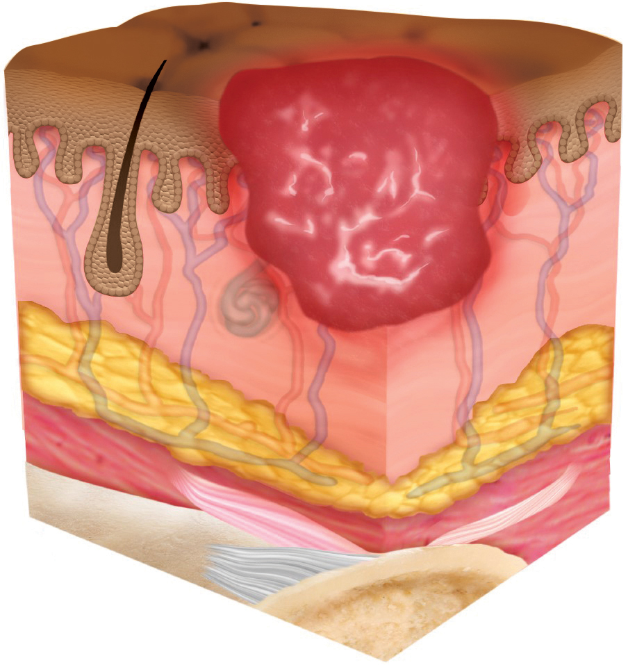 STK_Skin_Stage-2_dark Stage 2 pressure injury depicted as cross section through layers of skin