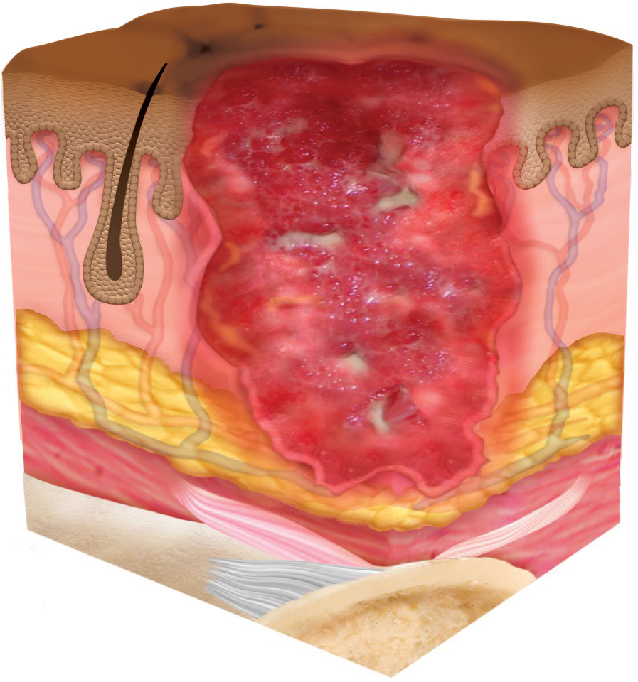 STK_Skin_Stage-3_dark Stage 3 pressure injury depicted as cross section through layers of skin