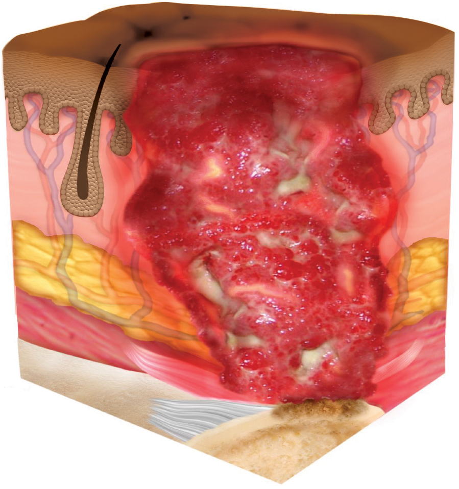 STK_Skin_Stage-4_dark Stage 4 pressure injury depicted as cross section through layers of skin