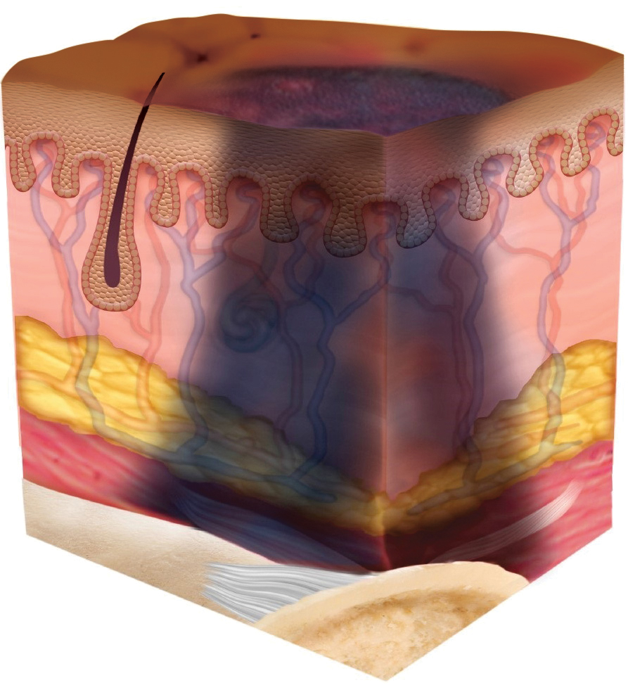 STK_Skin_Stage-Deep-Tissue_dark Deep tissue pressure injury depicted as cross section through layers of skin