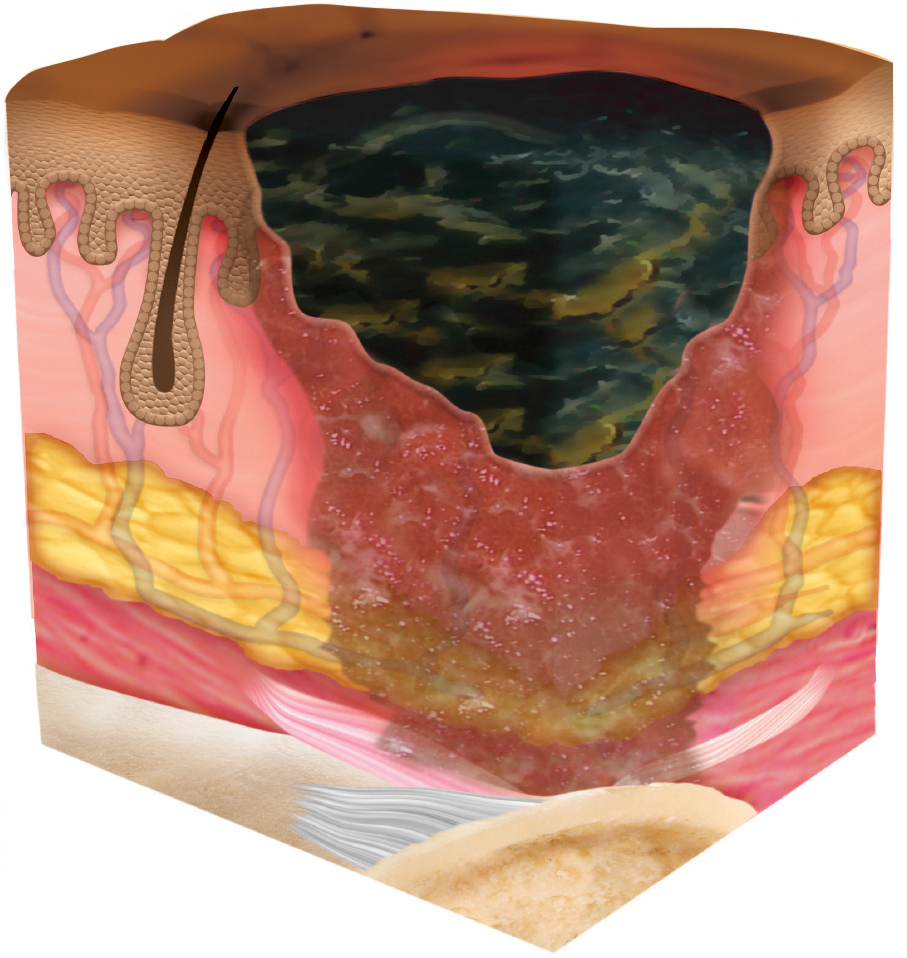 STK_Skin_Unstageable_dark Unstageable skin breakdown depicted as cross section through layers of skin