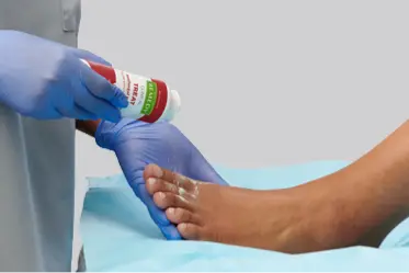 Gloved clinician hands sprinkle Remedy antifungal powder on patient’s diabetic feet.