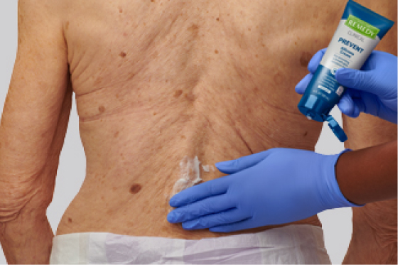 Gloved clinician hands apply Remedy barrier to dry skin on elderly patient’s back