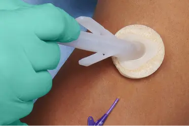 cleanse-skin Gloved hand cleanses the patient’s skin around the insertion site before putting in a catheter