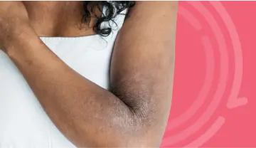 Dark skin tones: 6 tips to improve skin and wound outcomes