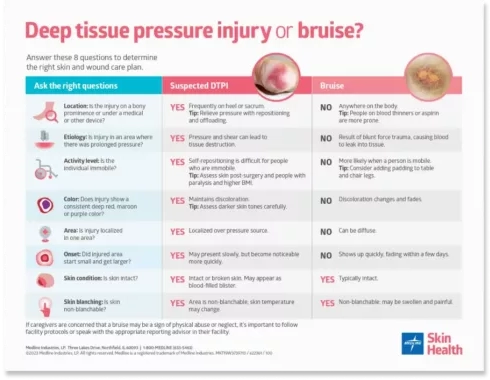 Deep tissue pressure injury or bruise poster thumbnail