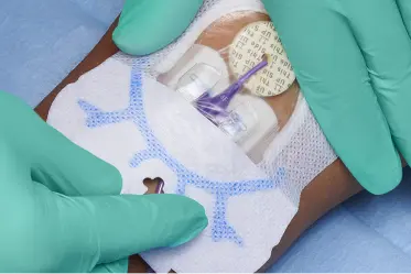protective-covering Gloved hands apply SorbaView SHIELD protective dressing and securement to catheter at insertion site