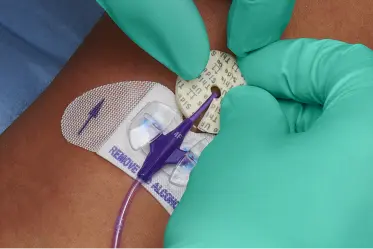 sponge-dressing Gloved hands apply a CHG sponge dressing