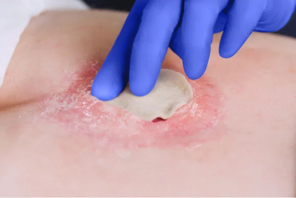 Clinician’s gloved hand applies dressing with antimicrobial agents to a wound with biofilm infection
