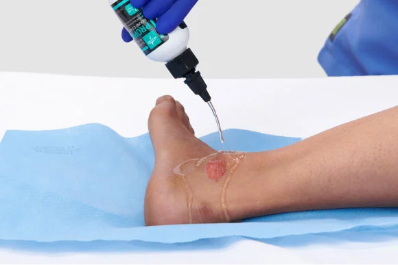 Clinician’s gloved hand applies dressing with antimicrobial agents to a wound with biofilm infection
