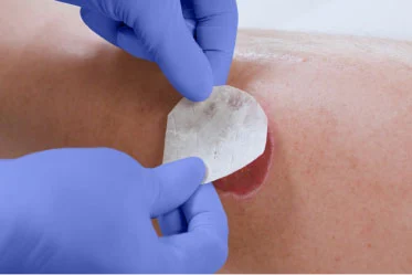 Clinician’s gloved hand applies iodine dressing to a knee wound with a chronic infection
